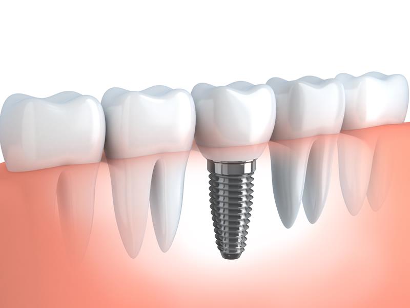 Dental Implants  Laurel, MS 
