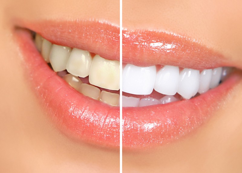 Teeth Whitening  Laurel, MS 